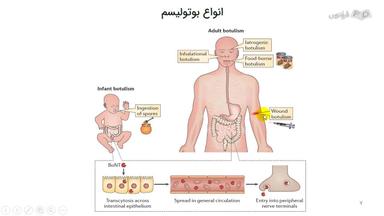 انواع بوتولیسم